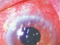 Ксерофтальмия или синдром сухого глаза