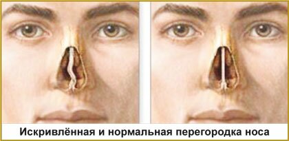 Искривленная и нормальная перегородка носа, септопластика Красноярск