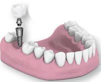 zubnoy-implantat-nedorogo-krasnoyarsk
