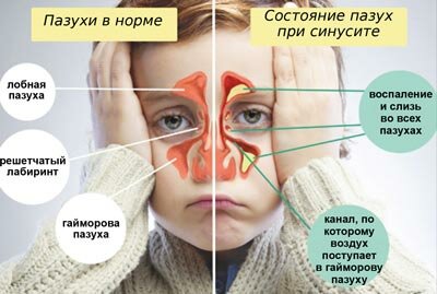Синусит. Лечение детского синусита в Красноярске.