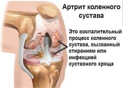 Артрит коленного сустава. Физиотерапия. магнитотерапия. Алмаг