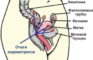 Лечение эндометриоза в Красноярске