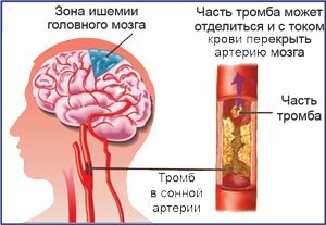Атеросклероз сонных артерий, транзиторные ишемические атаки, прием флеболога Красноярск
