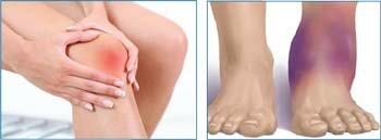 Восстановление после травм коленного, голеностопного сустава