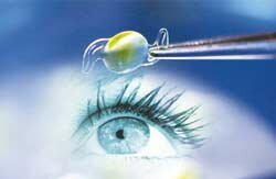Хирургия катаракты, замена хрусталика в Красноярске